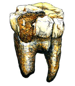 Backenzahn eines Australopithecus