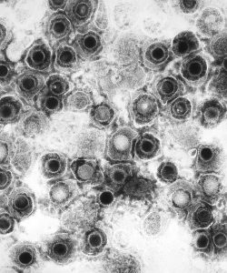 Transmissionselektronenmikroskopische (TEM) Aufnahme von Herpes-simplex-Viren