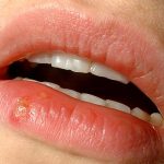 Lippenherpes