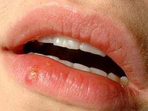 Lippenherpes