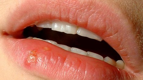 Lippenherpes