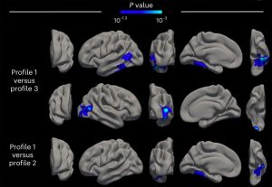 Gehirnscans